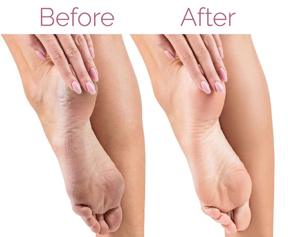 Evoli Callus Remover